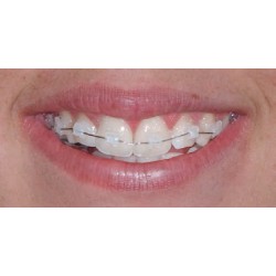 KIT ATTACCHI DB STEP 022 - CERAMICI - 1 CASO