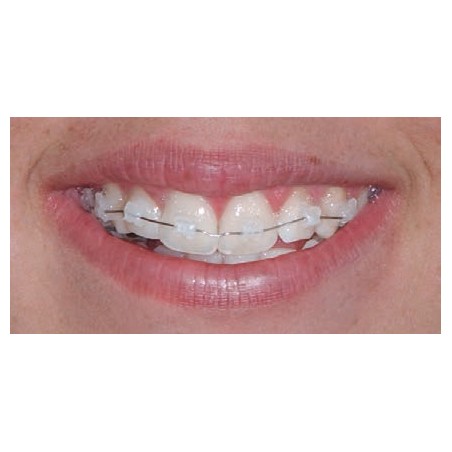 D.B. CERAMIC BRACKETS KIT