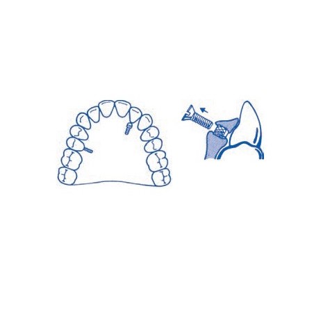 MICRO SPRING SCREWS KIT