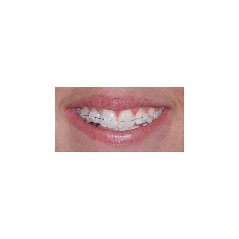 ATTACCHI D.B..022 CERAMICI 1pz